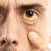 Yellowing of the skin and/or eyes (Jaundice)
