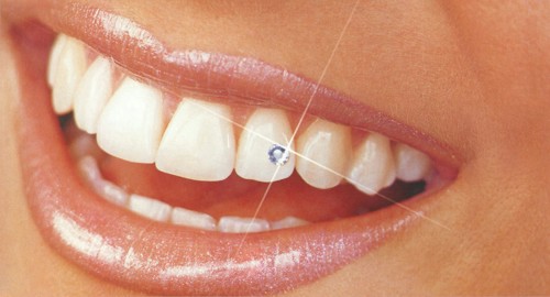http://kerekesdental.hu/s/kerekes_dental/it/77/77-1-tooth-piercing-1.jpg