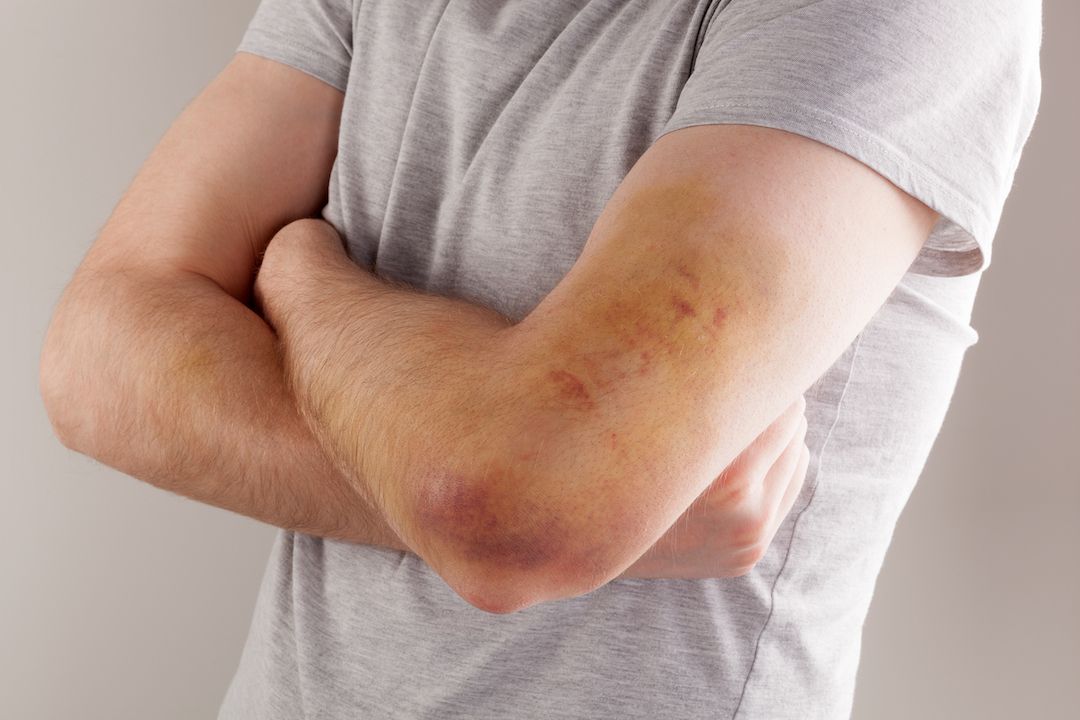 A man crossing his heavily bruised arms.