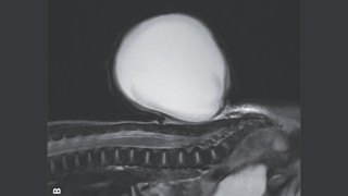 A black-and-white MRI image of the sac that was protruding from the newborn's spine. 