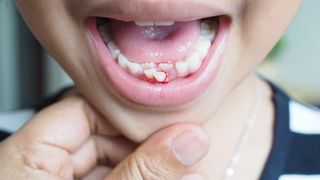 what causes bleeding gums