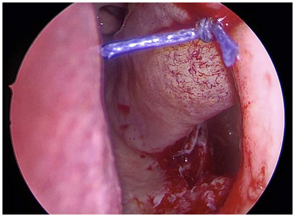 Inferior antrostomy is created after pre-lacrimal approach combined with medial maxillectomy.