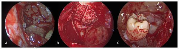 Pre-lacrimal approach is used to treat different maxillary sinus pathologies.