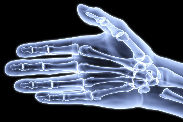 Dupuytren's contracture of the hand