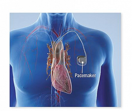 What you should know about recalls of cardiac devices featured image