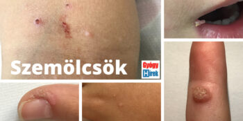 Vírusos szemölcsök gyermekkorban 2 szemölcsök