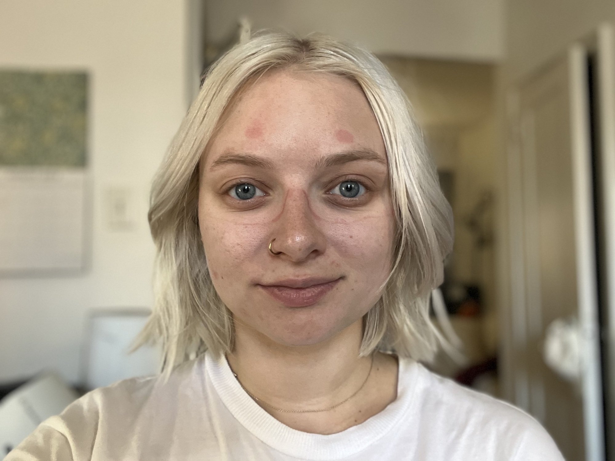 woman with red marks around her eyes and on her forehead