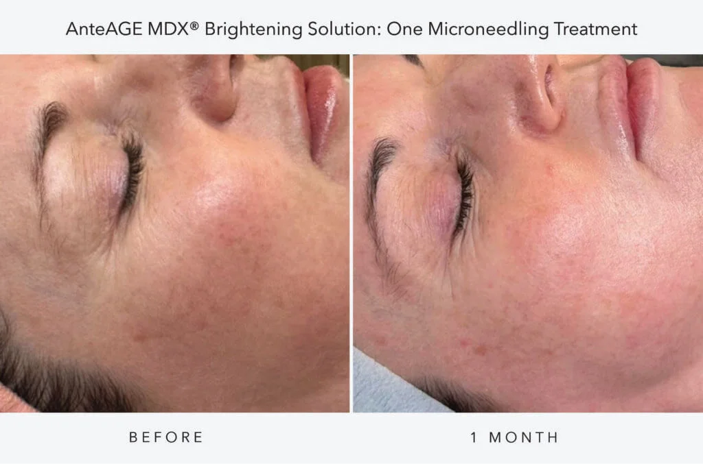 A woman is shown with her eyes closed, comparing her skin appearance before and after one microneedling treatment, highlighting changes in smoothness and clarity.