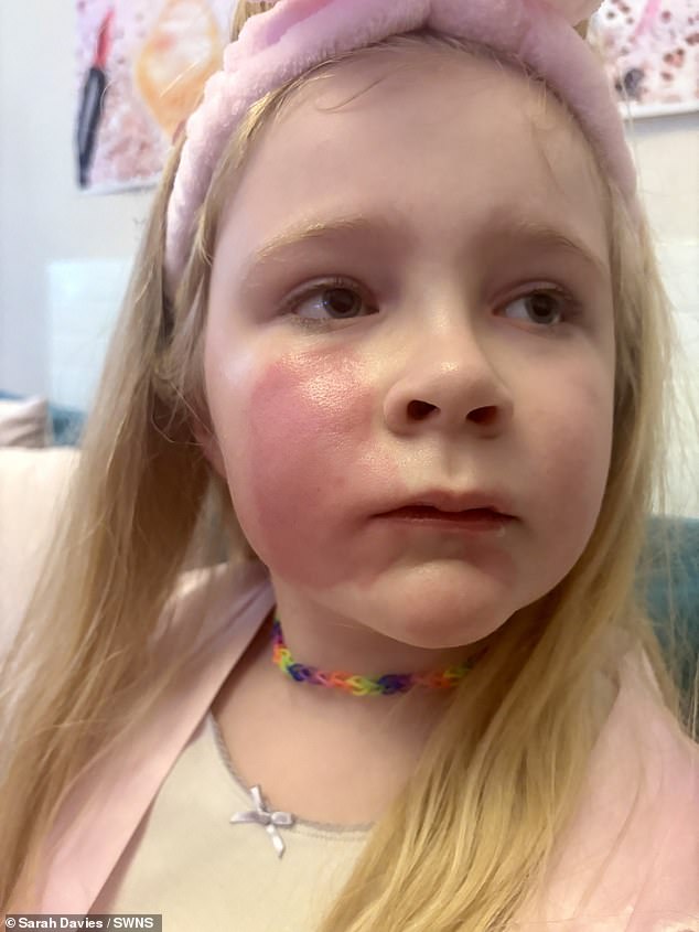 Sarah Davies rushed her eight year-old daughter to the pharmacist after she suffered a painful, red rash in reaction to a 'lip plumping' gloss