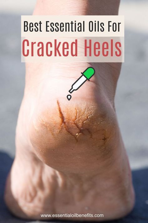 Healing Cracked Heels, How To Heal Cracked Heels, Seasickness Remedies, Essential Oils For Nails, Cracked Heels Remedy, Cracked Heel Remedy, Essential Oils Logo, Essential Ouls, Cracked Heel Remedies