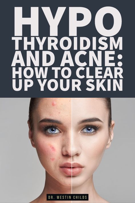 There is a strong connection between hypothyroidism and acne and that is exactly what this article is about. Your thyroid plays a role in the skin such that low thyroid function, hypothyroidism, and Hashimoto's thyroiditis can ALL lead to acne unless treated properly. Even some forms of severe acne can be treated with the right type of thyroid medication or thyroid management. There are also important nutrients that you should be taking if you have thyroid disease which can help clear your ... Thyroid Removal, Acne Pictures, Thyroid Remedies, Low Thyroid, Thyroid Symptoms, Hashimotos Disease, Thyroid Medication, Severe Acne, Types Of Acne