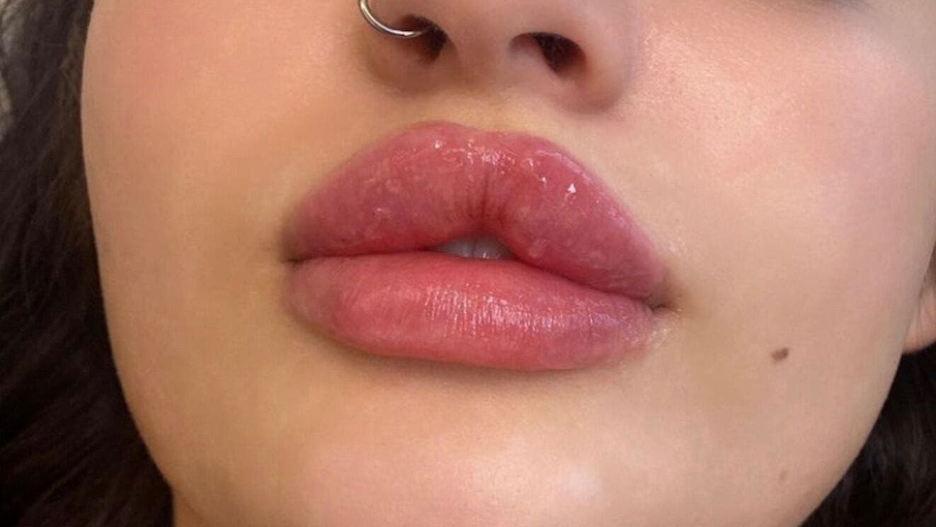 Close-up of enhanced lips at Beauty Fillers Dermal Aesthetics, London, England, GB.