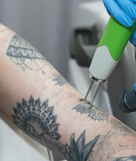 Lazer Wizard Tattoo Removal afbeelding 2