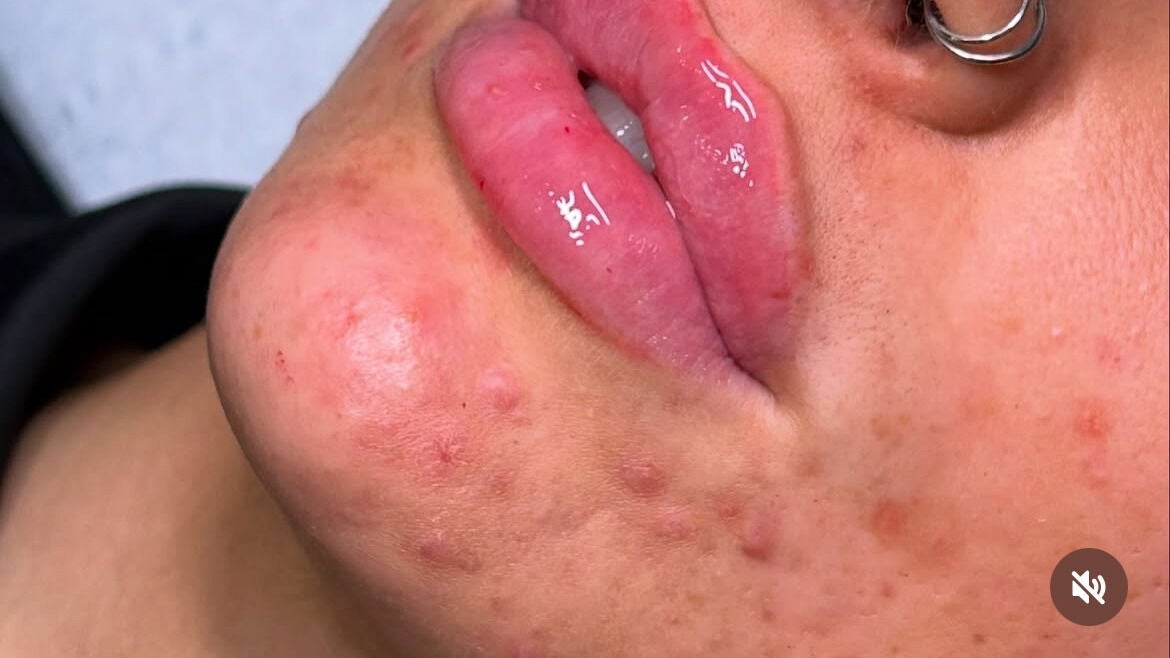 Close-up of skincare treatment at AC Aesthetics & Wellness Limerick, Limerick, County Limerick, IE.