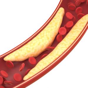 閉経後はLDLコレステロール180mg/dL未満なら治療の必要はない!?循環器専門医からの新常識