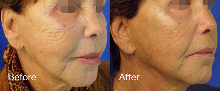 Before and After_X 297 720 2
