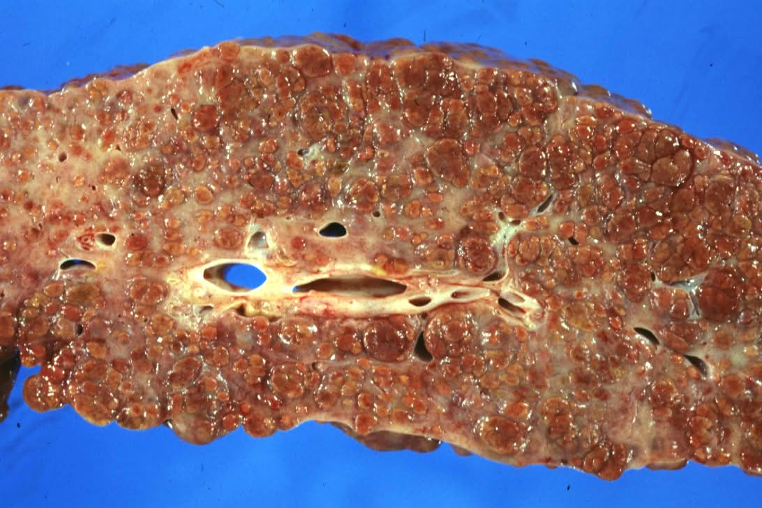 Cirrhosis Endstage