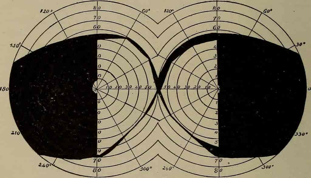 Synsfelt ved bitemporal hemianopsi