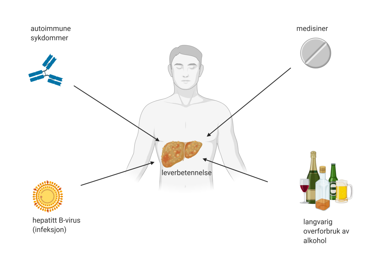 Årsaker til leverbetennelse