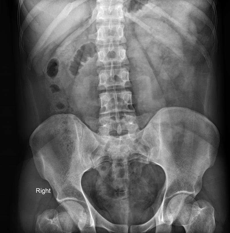 Normal urografi. Bilde før og etter utskillelse av kontrast til urinveier og urinblæren (nederst).