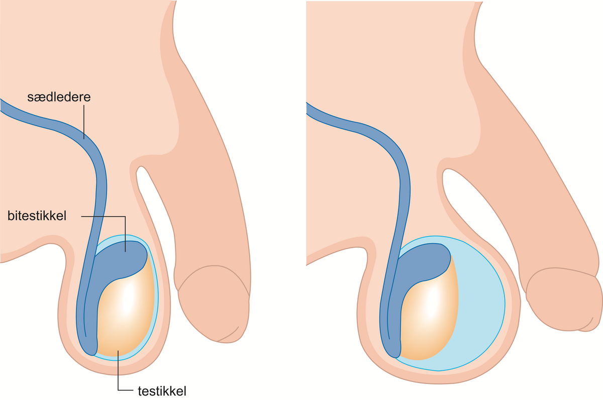 Hydrocele.