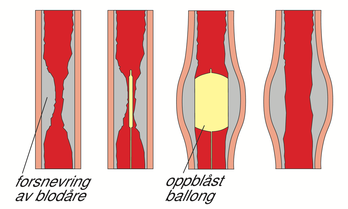 Ballongbehandling.