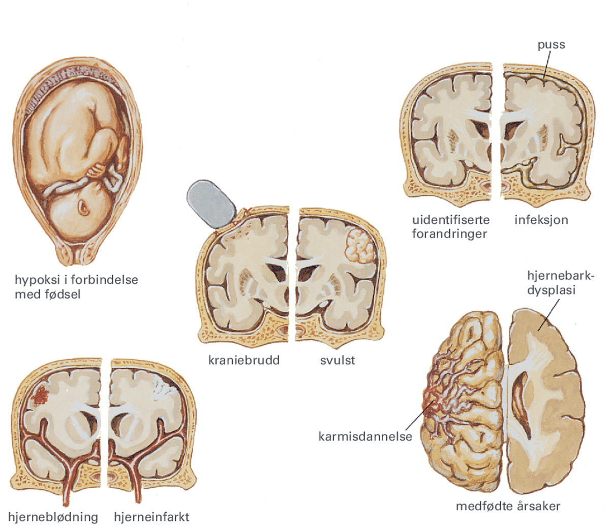 epilepsi