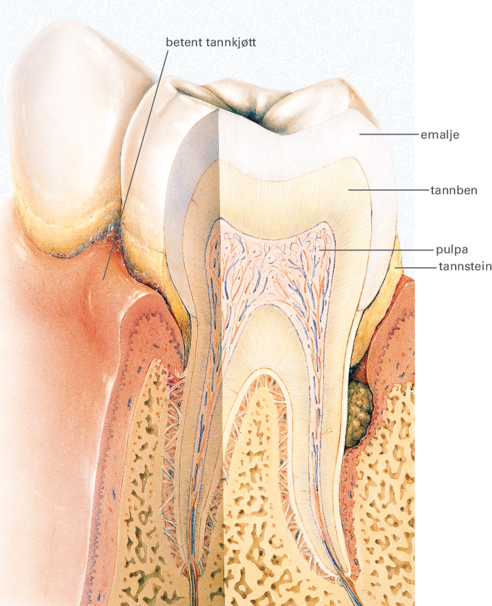 Periodontitt.