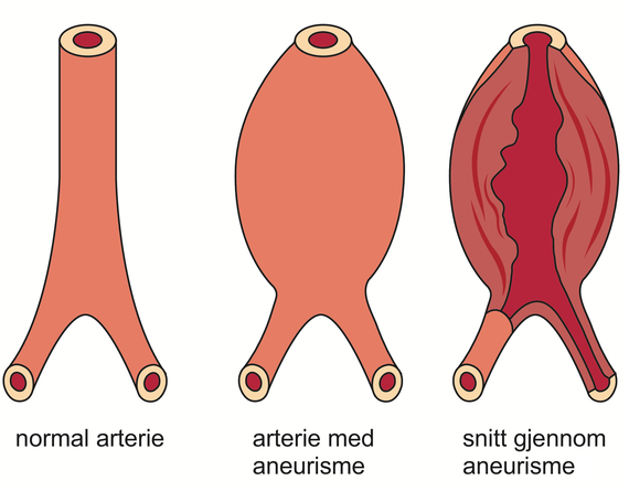 aneurisme