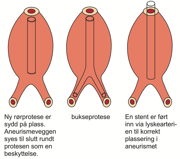 Proteser