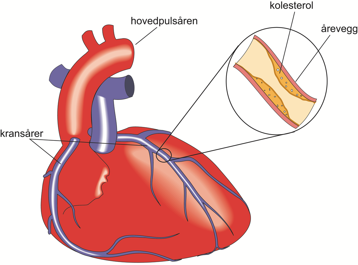 angina pectoris