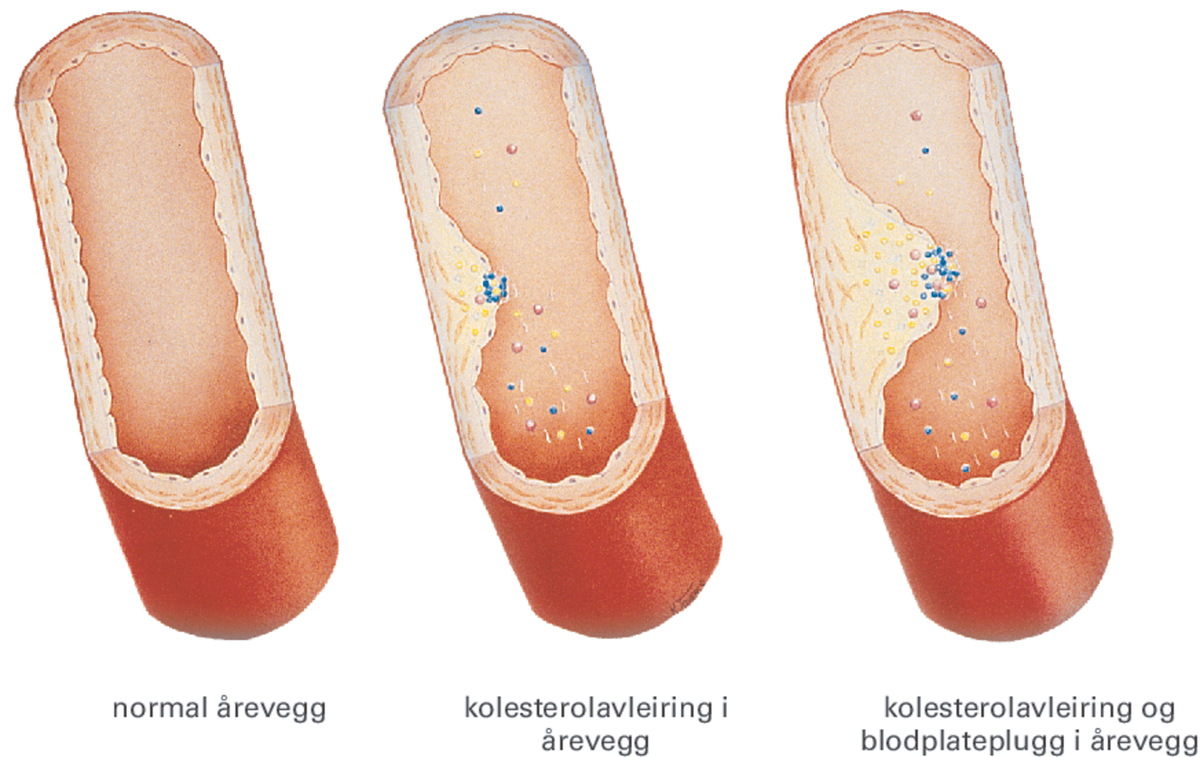 Kolesterol.