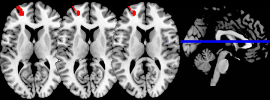 BrainMeditation