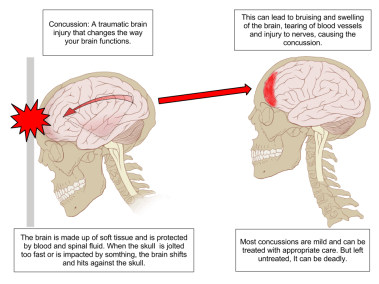 Concussion