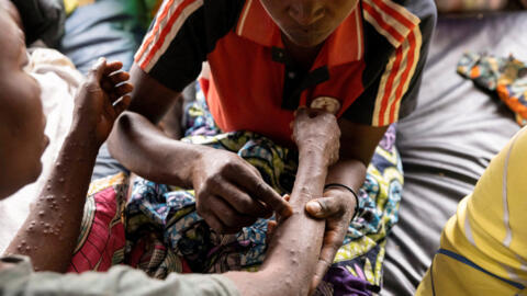 A patient with mpox being treated in South Kivu province, Democratic Republic of Congo, in August. An outbreak in DRC that has spread to neighbouring countries has put the World Health Organization on alert, declaring mpox a global public health emergency.