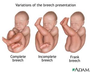 BreechPositions2