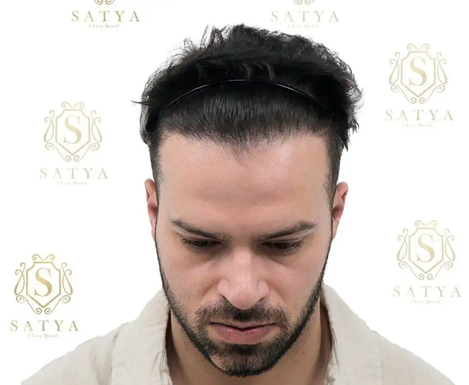 Hair Transplant Cost in India