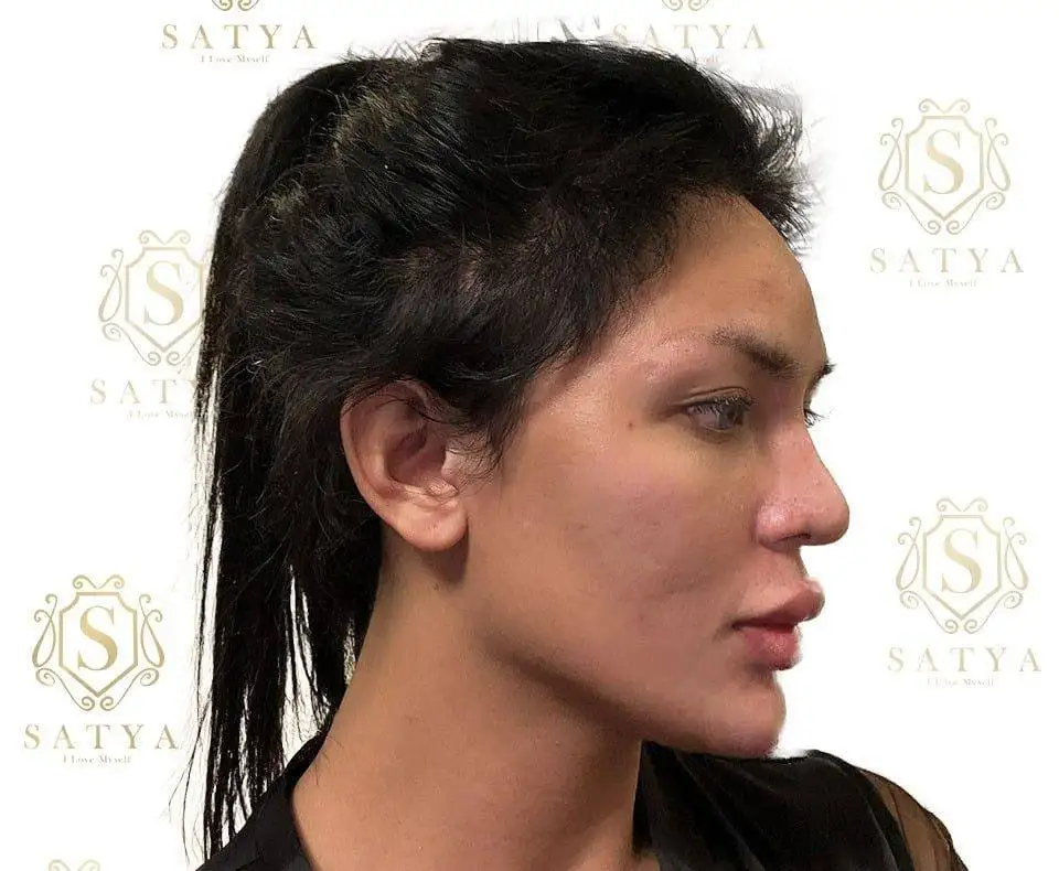 Hair Transplant Cost in India