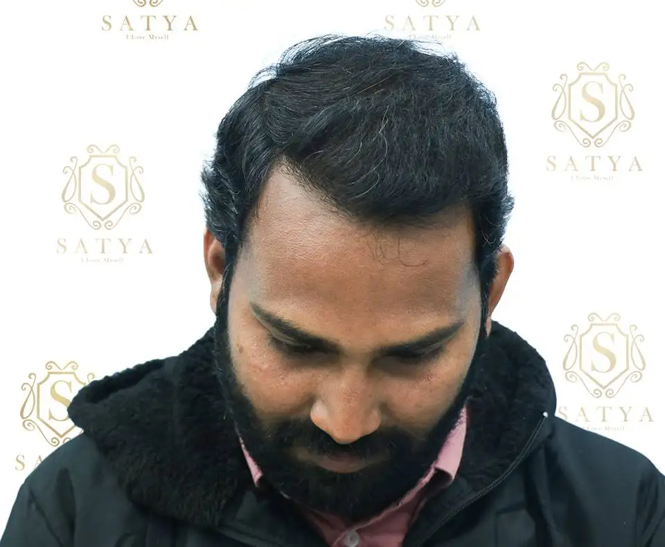 Hair Transplant Cost in India