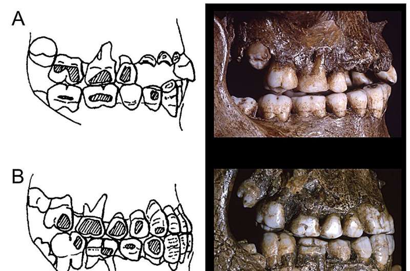 Flat patches on the sides of teeth of ancient Europeans may have been due to labrets