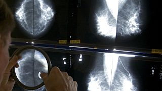 ARQUIVO - Um radiologista usa uma lupa para verificar se as mamografias denotam cancro da mama, em Los Angeles.