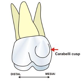 カラベリー結節