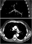 CT pulmonary angiography showing a "saddle embolus" at the bifurcation of the main pulmonary artery and thrombus burden in the lobar arteries on both sides