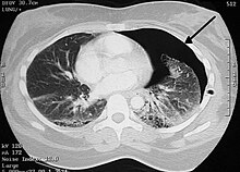 Image from a computed tomography (CT) scan of the chest. On the right (left side of the patient) there is a black area suggesting free air inside the chest