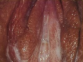 vulva met gonorroe