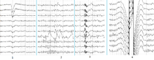 Main types of artifacts in human EEG