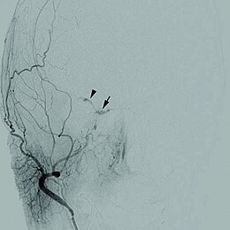 Description de l'image 1471-2415-12-28-1Cerebral angiogram.jpg.