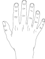 Polydactyly, 6 fingers