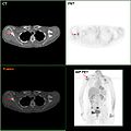 F-18 FDG PET / CT: A انبثاث سرطان الثدي للوح الكتف الأيمن