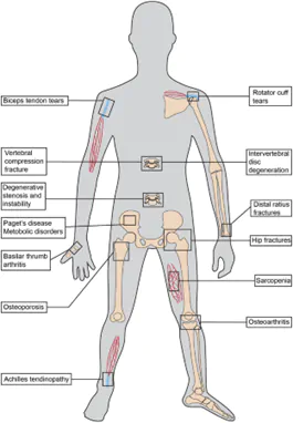 osteoporosis and bone strength information.